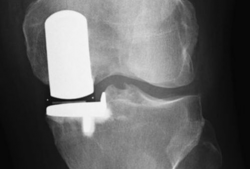 膝关节置换手术视频,从术前准备到术后康复